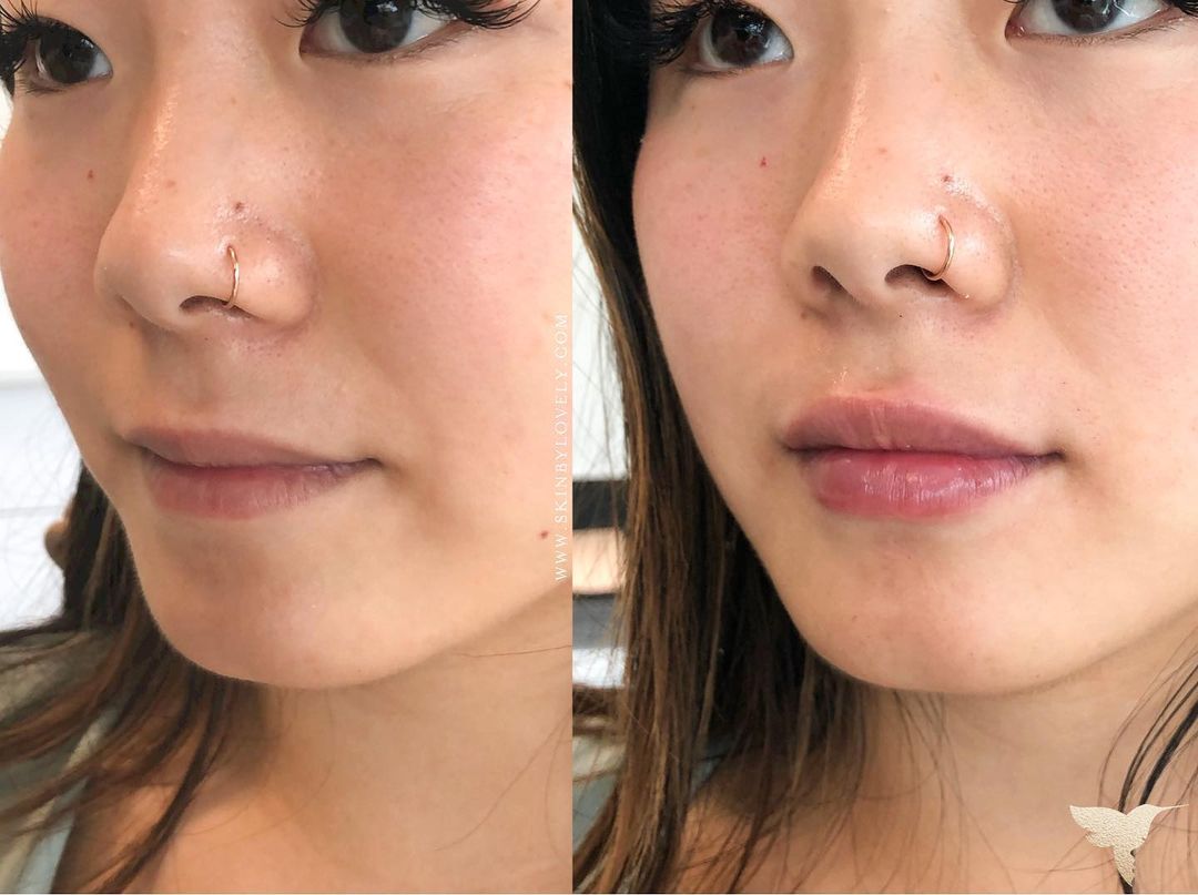 Juverderm – Hochwertige Filler für Volumen und Glätte